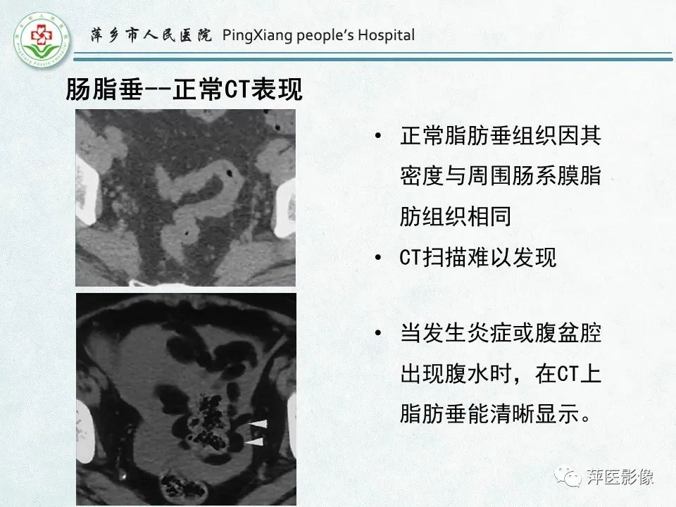 影像PPT - 【PPT】右下腹相关炎性病变-59
