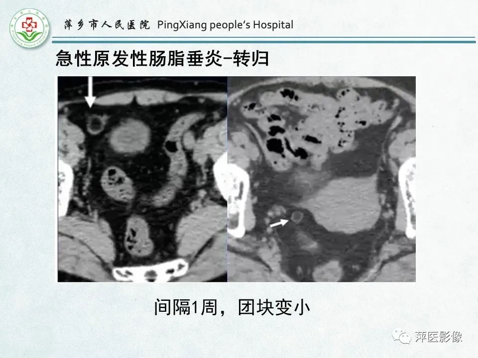 影像PPT - 【PPT】右下腹相关炎性病变-70