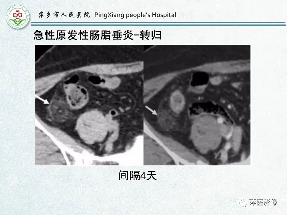 影像PPT - 【PPT】右下腹相关炎性病变-69