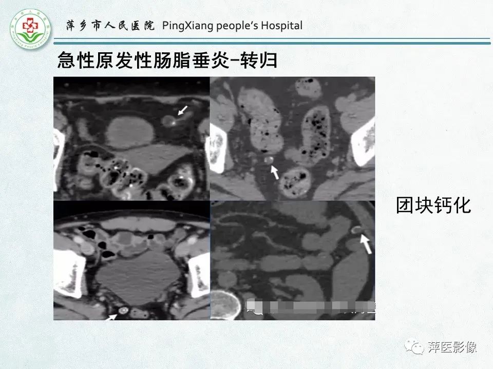 影像PPT - 【PPT】右下腹相关炎性病变-71