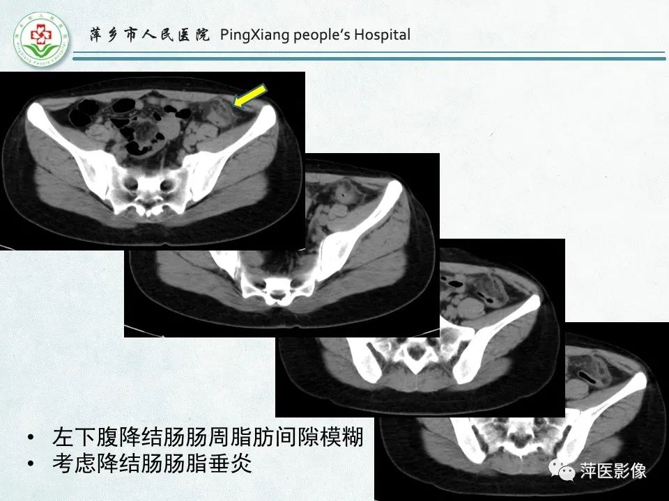 影像PPT - 【PPT】右下腹相关炎性病变-72