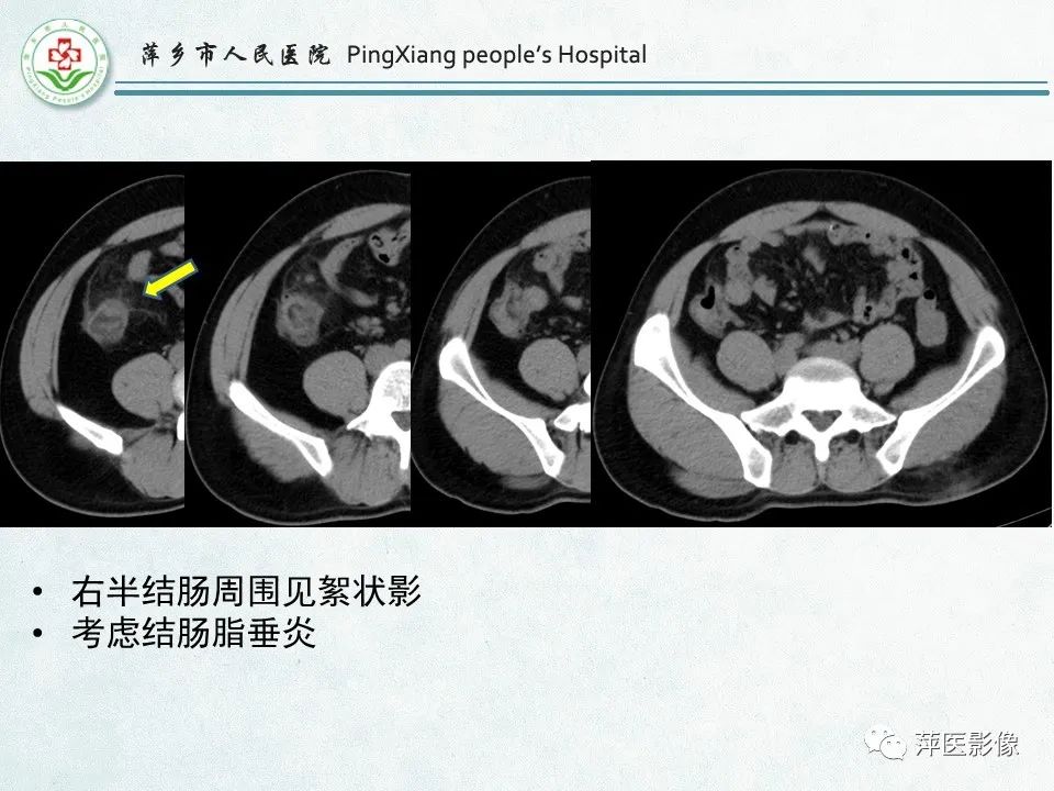 影像PPT - 【PPT】右下腹相关炎性病变-74