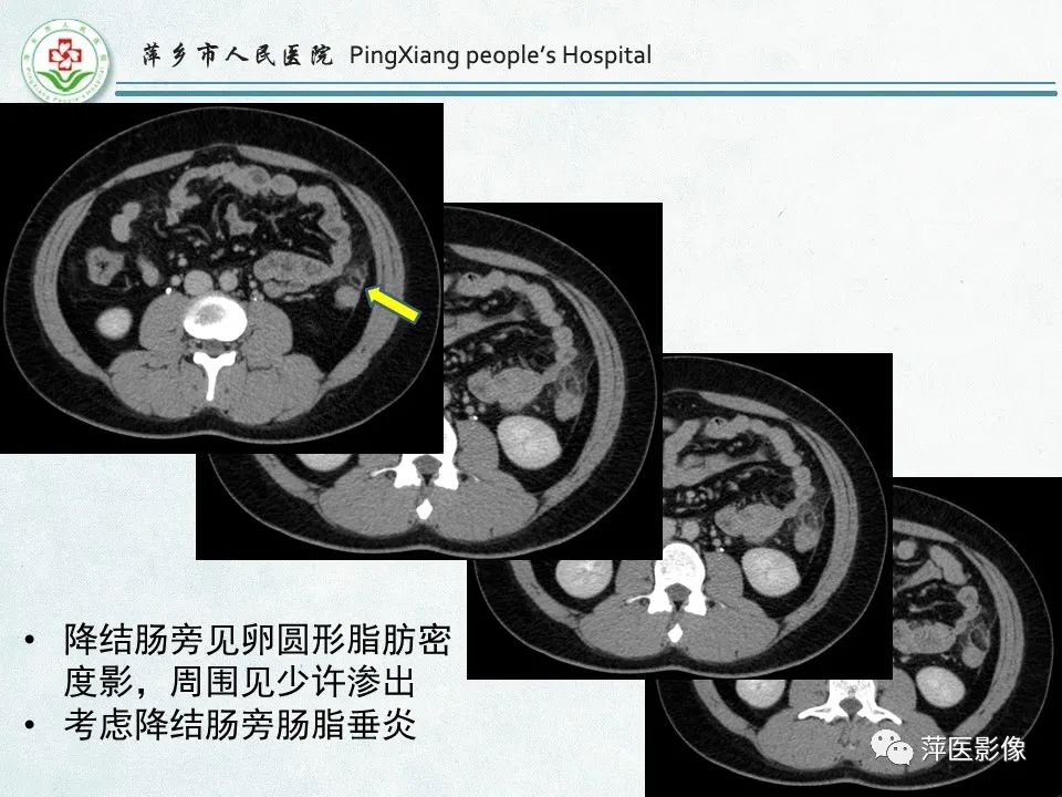 影像PPT - 【PPT】右下腹相关炎性病变-73