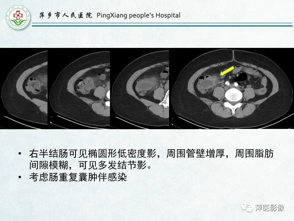 影像PPT - 【PPT】右下腹相关炎性病变-87