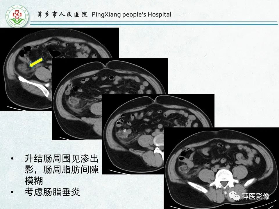 影像PPT - 【PPT】右下腹相关炎性病变-75