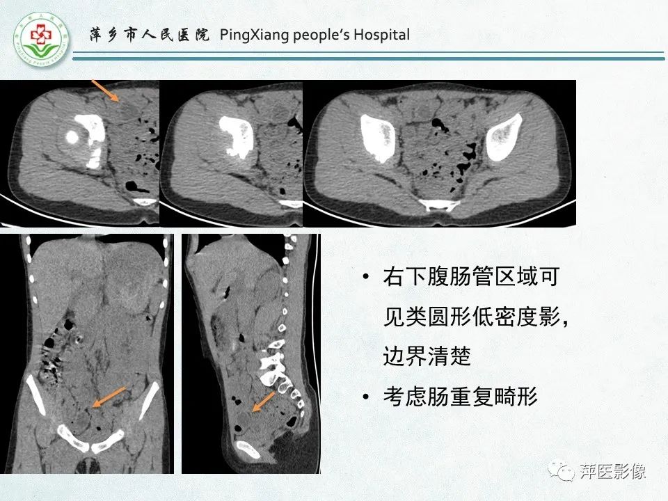影像PPT - 【PPT】右下腹相关炎性病变-88