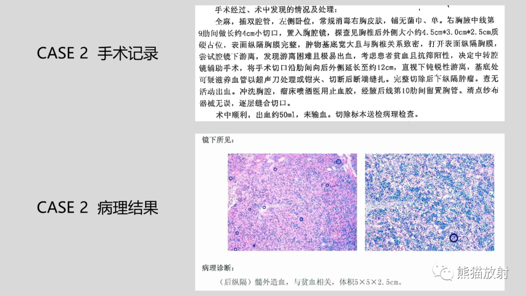 影像PPT - 【病例】髓外造血2例CT影像-21