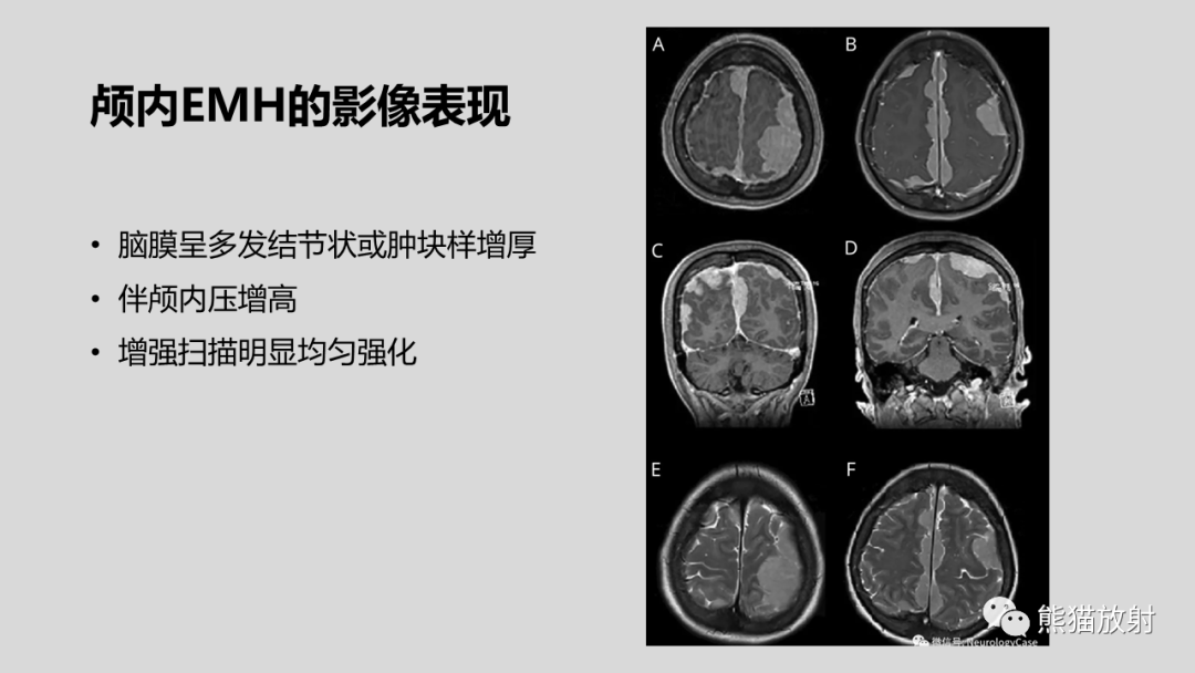 影像PPT - 【病例】髓外造血2例CT影像-27