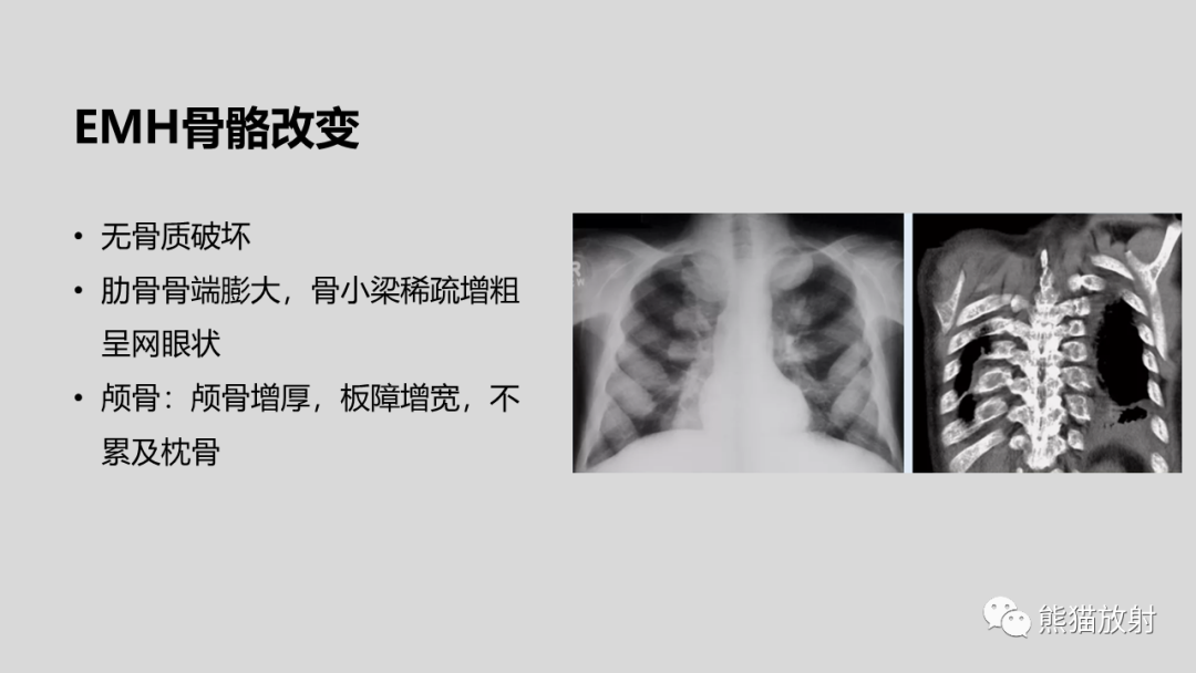 影像PPT - 【病例】髓外造血2例CT影像-28