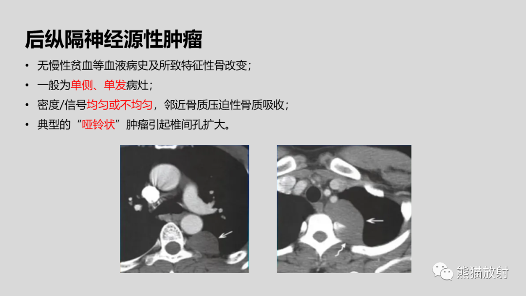影像PPT - 【病例】髓外造血2例CT影像-34