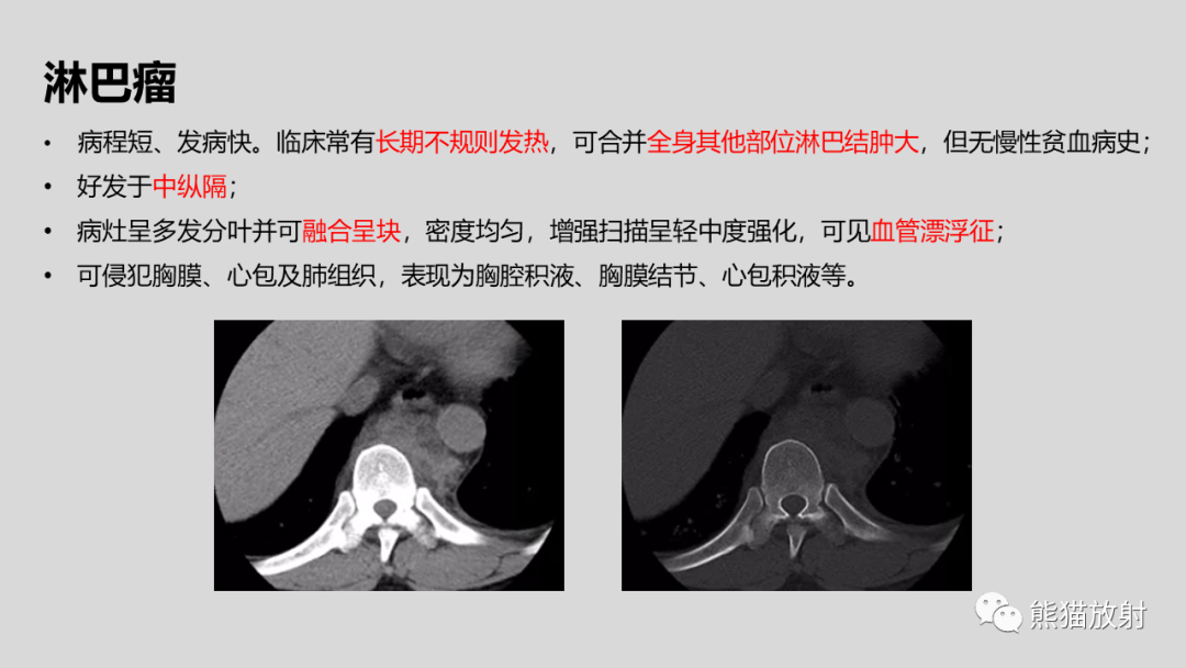 影像PPT - 【病例】髓外造血2例CT影像-35