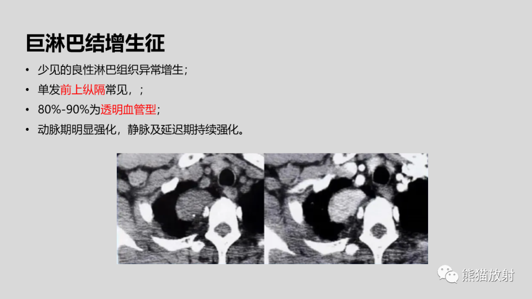 影像PPT - 【病例】髓外造血2例CT影像-37