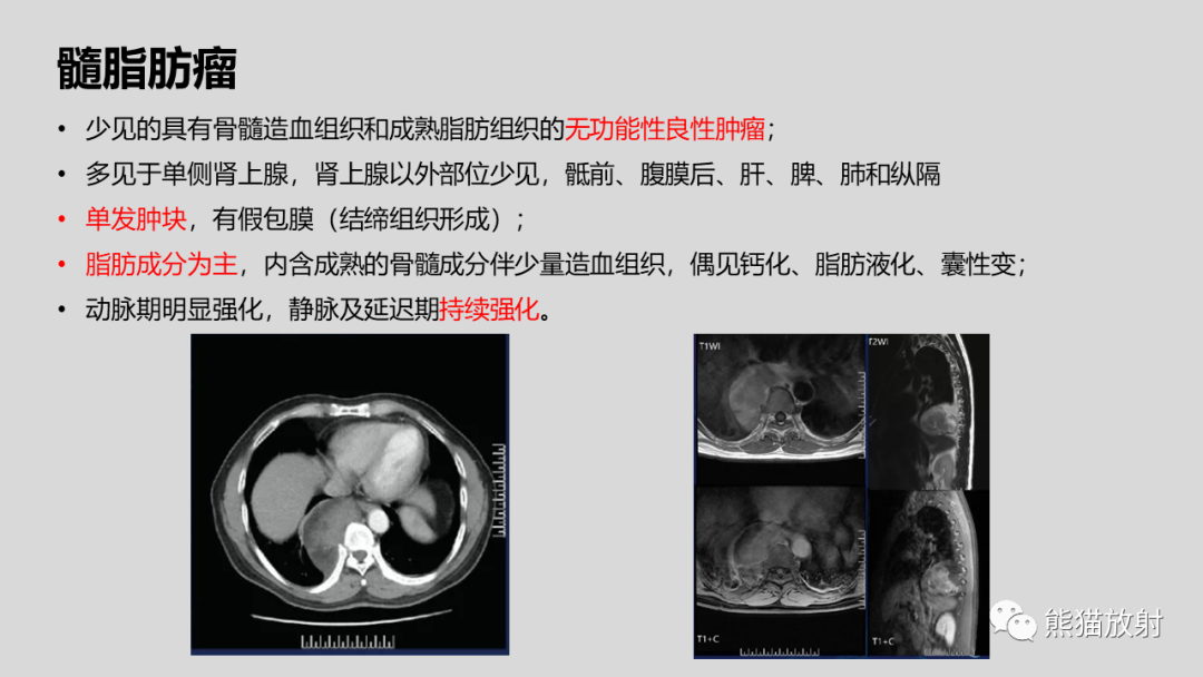 影像PPT - 【病例】髓外造血2例CT影像-38