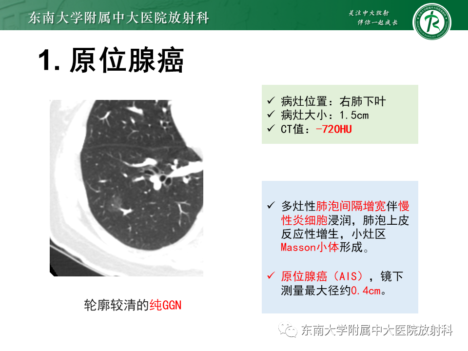 影像PPT - 【PPT】理影外合—肺腺癌疾病谱-17 影像PPT - 【PPT】理影外合—肺腺癌疾病谱-17