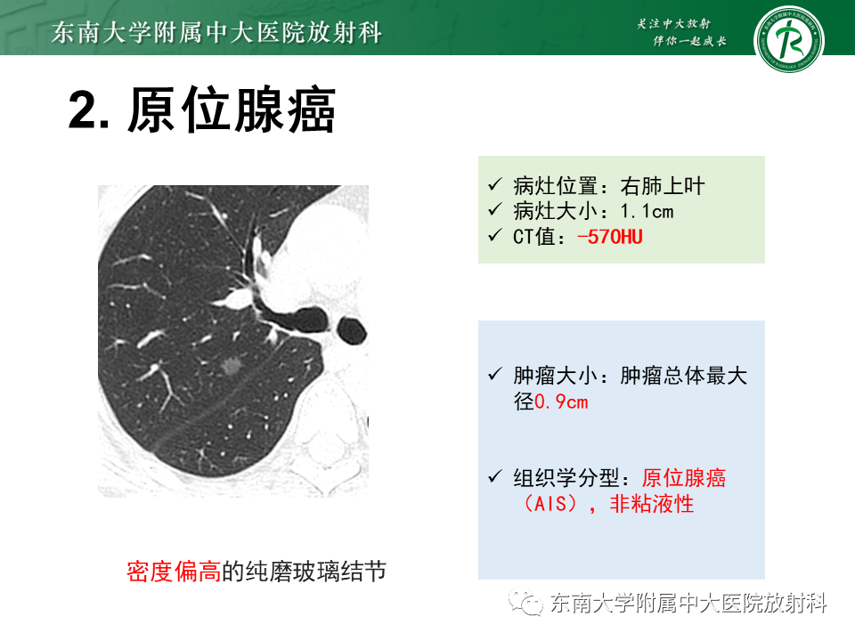 影像PPT - 【PPT】理影外合—肺腺癌疾病谱-18 影像PPT - 【PPT】理影外合—肺腺癌疾病谱-18