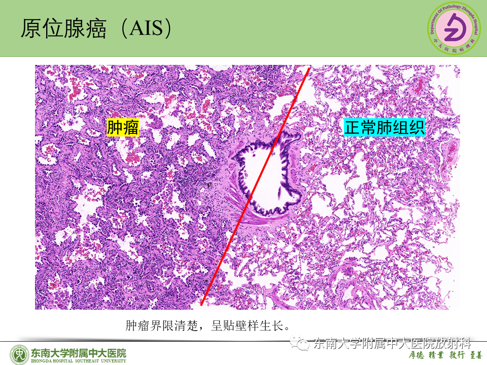 影像PPT - 【PPT】理影外合—肺腺癌疾病谱-28 影像PPT - 【PPT】理影外合—肺腺癌疾病谱-28