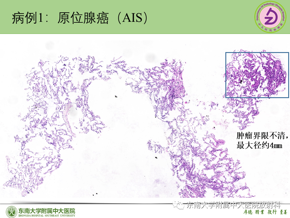 影像PPT - 【PPT】理影外合—肺腺癌疾病谱-25 影像PPT - 【PPT】理影外合—肺腺癌疾病谱-25