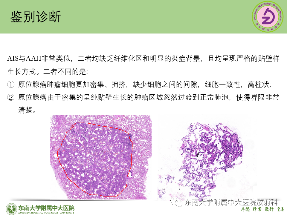 影像PPT - 【PPT】理影外合—肺腺癌疾病谱-31 影像PPT - 【PPT】理影外合—肺腺癌疾病谱-31
