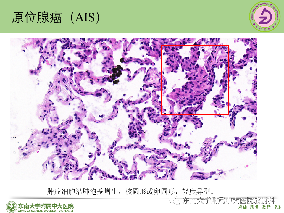 影像PPT - 【PPT】理影外合—肺腺癌疾病谱-26 影像PPT - 【PPT】理影外合—肺腺癌疾病谱-26