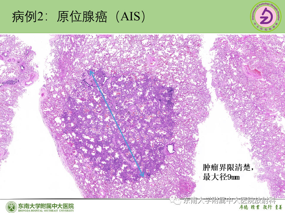 影像PPT - 【PPT】理影外合—肺腺癌疾病谱-27 影像PPT - 【PPT】理影外合—肺腺癌疾病谱-27