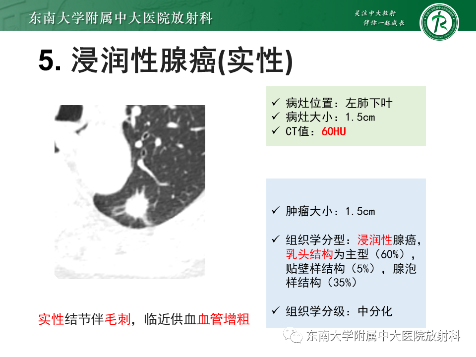 影像PPT - 【PPT】理影外合—肺腺癌疾病谱-21 影像PPT - 【PPT】理影外合—肺腺癌疾病谱-21
