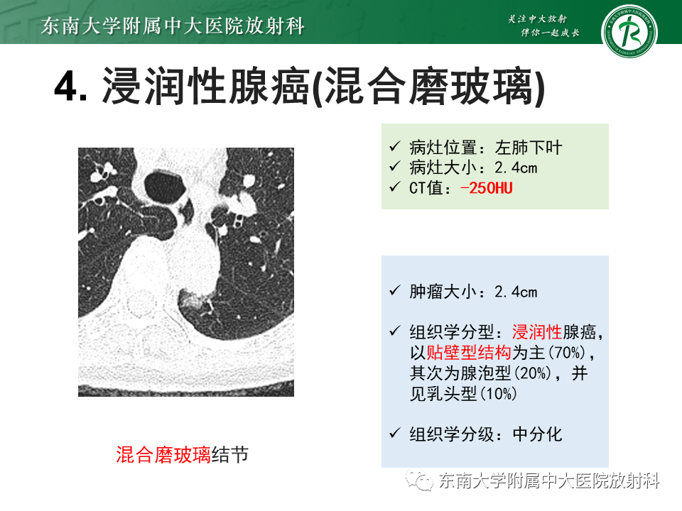 影像PPT - 【PPT】理影外合—肺腺癌疾病谱-20 影像PPT - 【PPT】理影外合—肺腺癌疾病谱-20