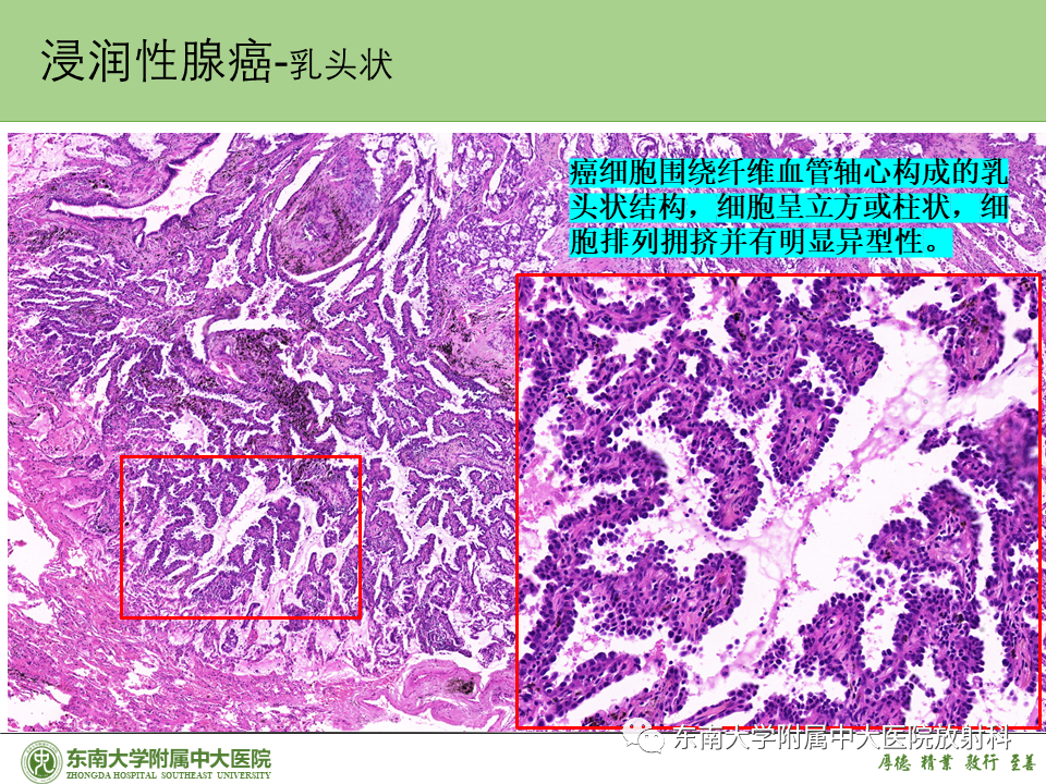 影像PPT - 【PPT】理影外合—肺腺癌疾病谱-40 影像PPT - 【PPT】理影外合—肺腺癌疾病谱-40