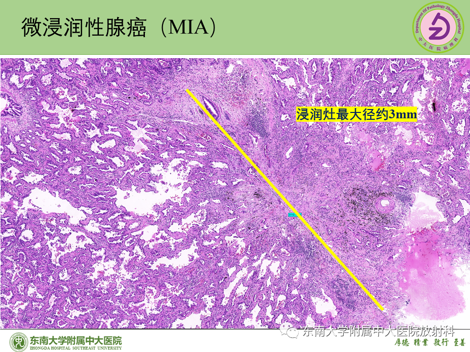影像PPT - 【PPT】理影外合—肺腺癌疾病谱-34 影像PPT - 【PPT】理影外合—肺腺癌疾病谱-34