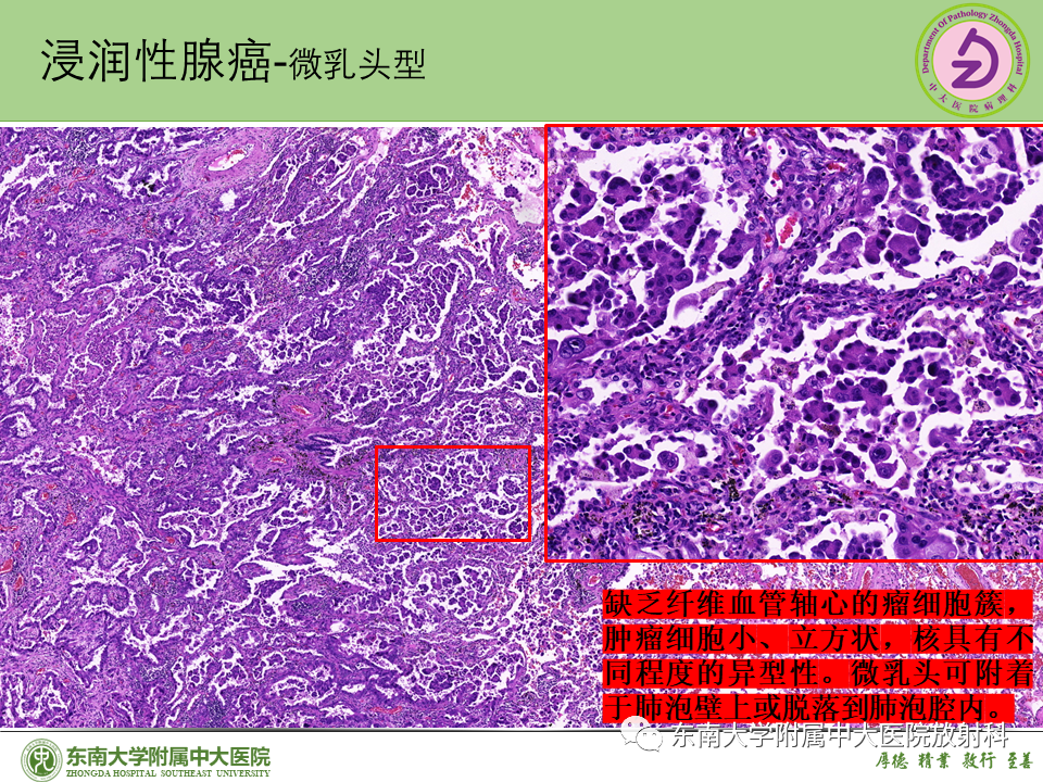 影像PPT - 【PPT】理影外合—肺腺癌疾病谱-42 影像PPT - 【PPT】理影外合—肺腺癌疾病谱-42