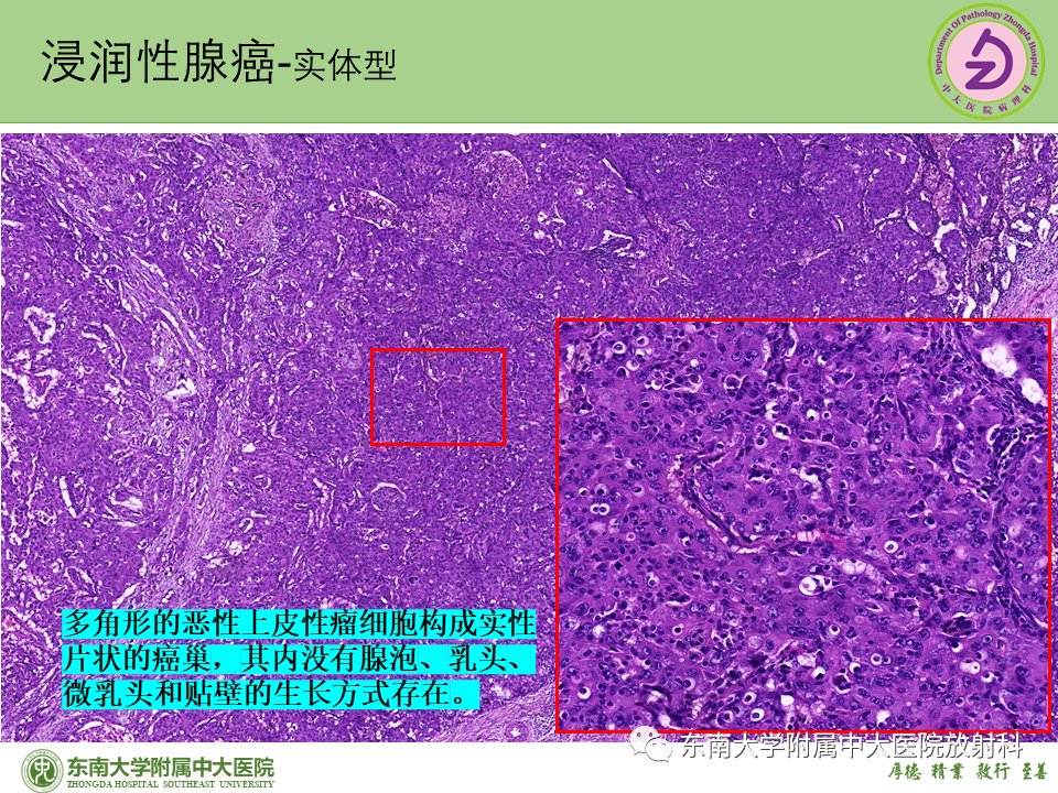影像PPT - 【PPT】理影外合—肺腺癌疾病谱-44 影像PPT - 【PPT】理影外合—肺腺癌疾病谱-44