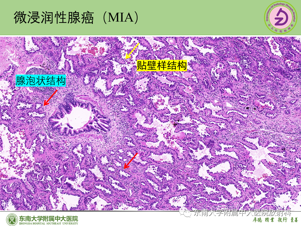 影像PPT - 【PPT】理影外合—肺腺癌疾病谱-33 影像PPT - 【PPT】理影外合—肺腺癌疾病谱-33