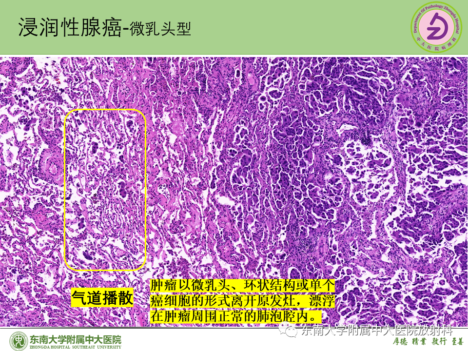 影像PPT - 【PPT】理影外合—肺腺癌疾病谱-43 影像PPT - 【PPT】理影外合—肺腺癌疾病谱-43