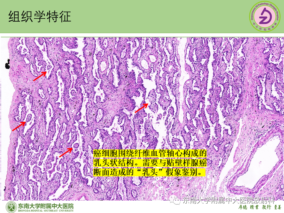 影像PPT - 【PPT】理影外合—肺腺癌疾病谱-38 影像PPT - 【PPT】理影外合—肺腺癌疾病谱-38