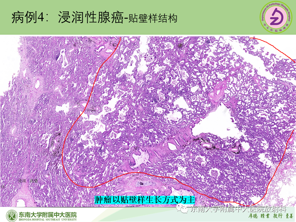 影像PPT - 【PPT】理影外合—肺腺癌疾病谱-37 影像PPT - 【PPT】理影外合—肺腺癌疾病谱-37