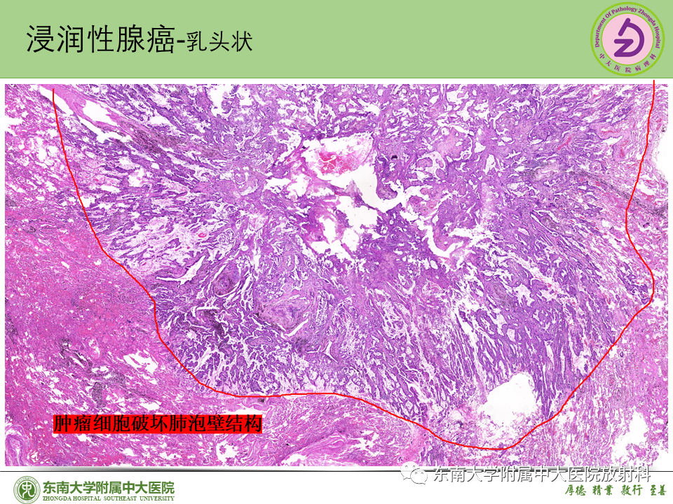 影像PPT - 【PPT】理影外合—肺腺癌疾病谱-39 影像PPT - 【PPT】理影外合—肺腺癌疾病谱-39