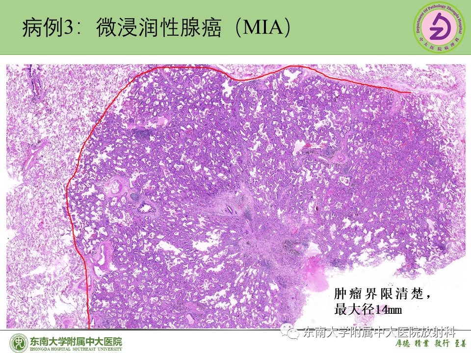 影像PPT - 【PPT】理影外合—肺腺癌疾病谱-32 影像PPT - 【PPT】理影外合—肺腺癌疾病谱-32