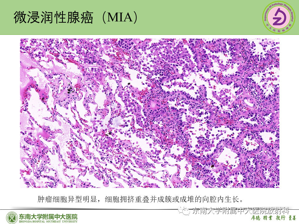 影像PPT - 【PPT】理影外合—肺腺癌疾病谱-35 影像PPT - 【PPT】理影外合—肺腺癌疾病谱-35