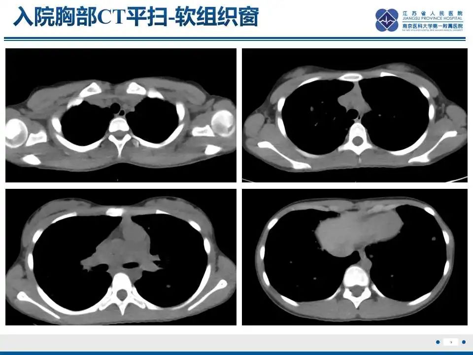 影像PPT - 【PPT】腺泡状软组织肉瘤-4