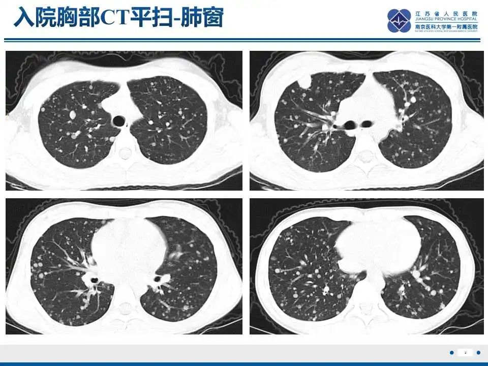 影像PPT - 【PPT】腺泡状软组织肉瘤-3