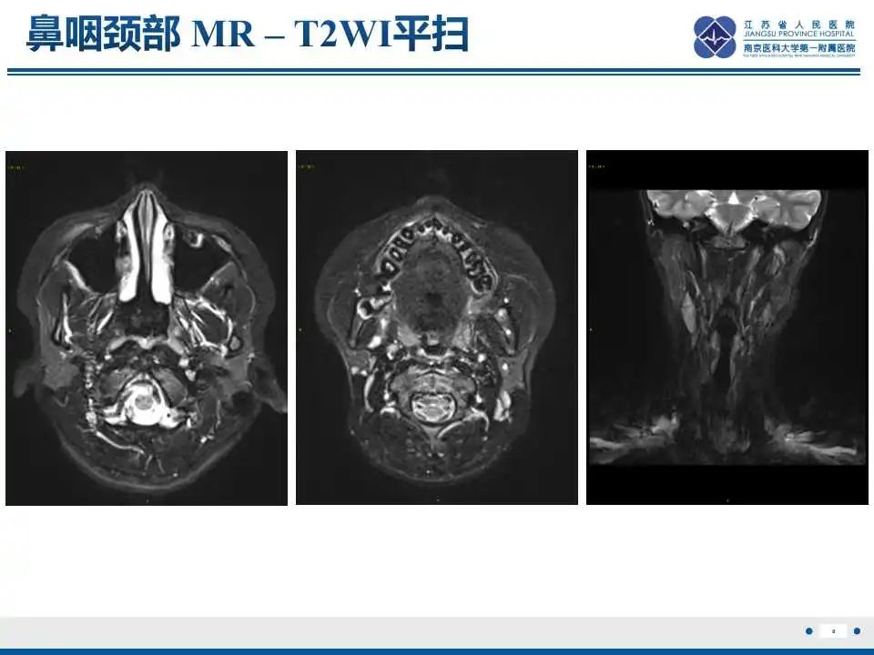 影像PPT - 【PPT】腺泡状软组织肉瘤-9