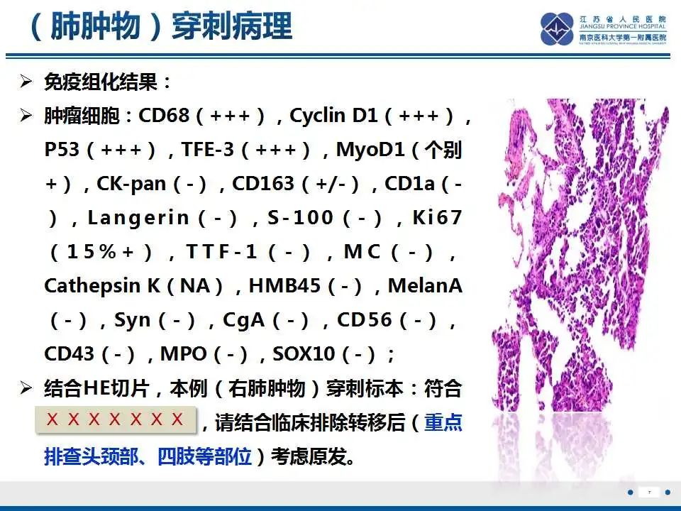 影像PPT - 【PPT】腺泡状软组织肉瘤-8