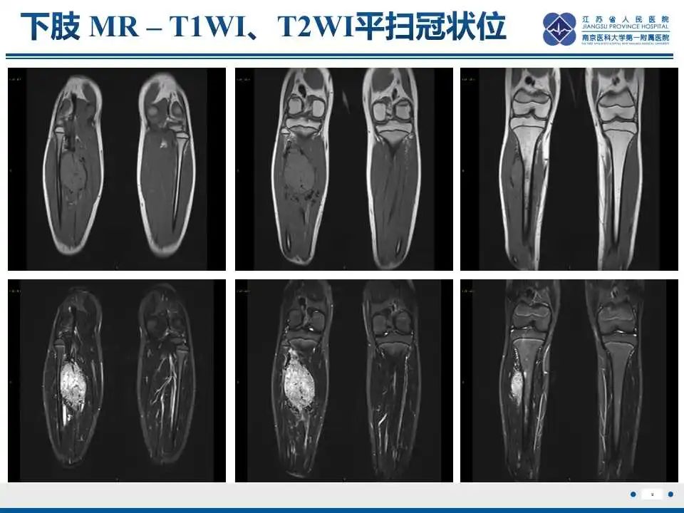影像PPT - 【PPT】腺泡状软组织肉瘤-10