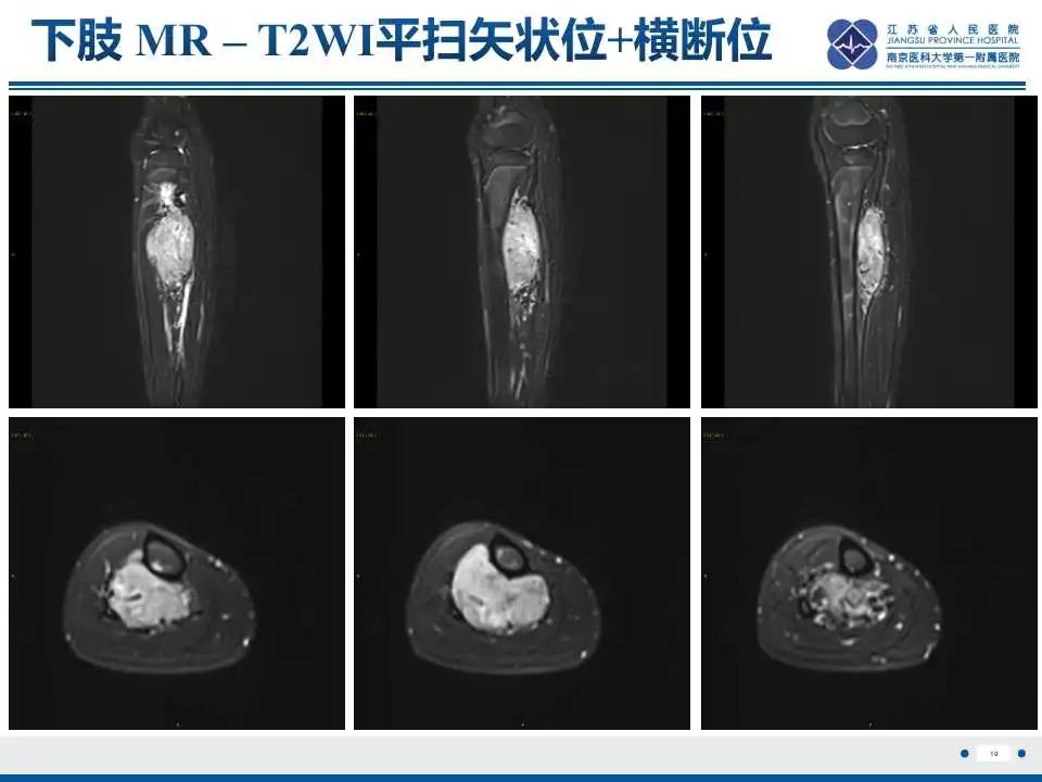 影像PPT - 【PPT】腺泡状软组织肉瘤-11