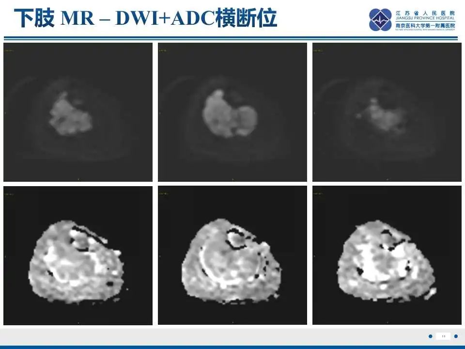 影像PPT - 【PPT】腺泡状软组织肉瘤-12