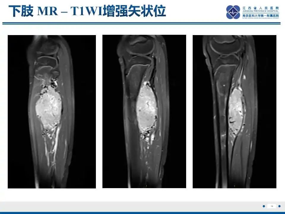 影像PPT - 【PPT】腺泡状软组织肉瘤-14