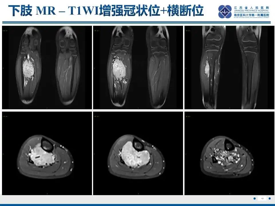 影像PPT - 【PPT】腺泡状软组织肉瘤-13