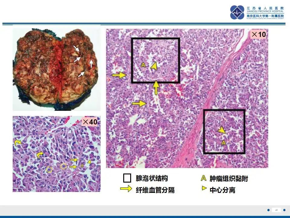 影像PPT - 【PPT】腺泡状软组织肉瘤-22