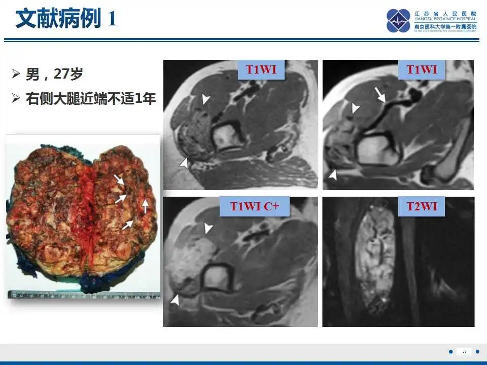 影像PPT - 【PPT】腺泡状软组织肉瘤-24