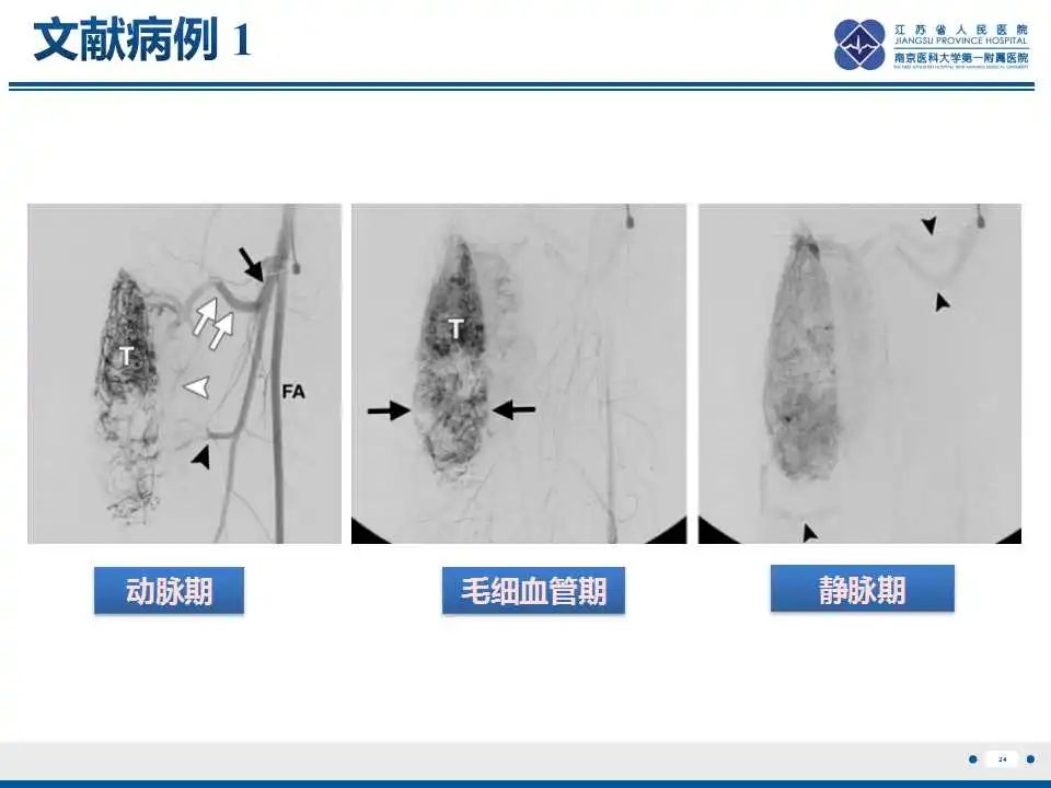 影像PPT - 【PPT】腺泡状软组织肉瘤-25