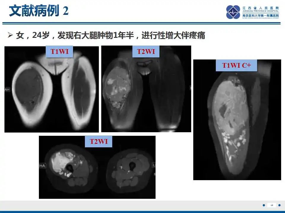 影像PPT - 【PPT】腺泡状软组织肉瘤-26